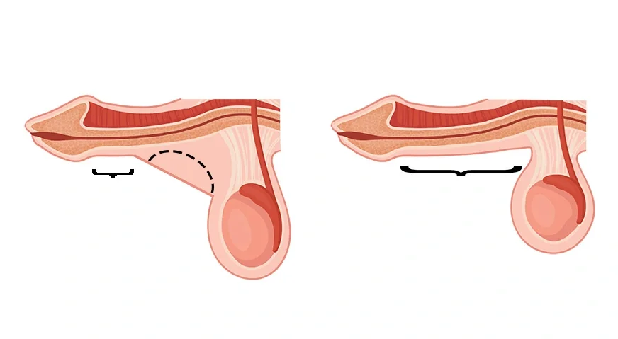 Escrotoplastia: o que é, quando é indicada e como é a recuperação
